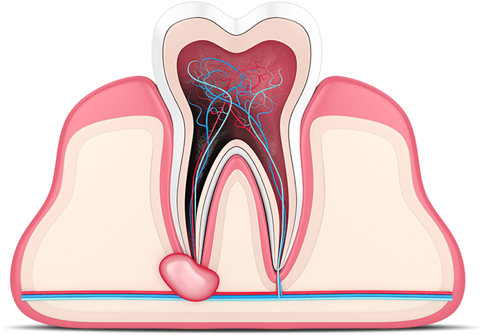 How Root Canals Save Teeth