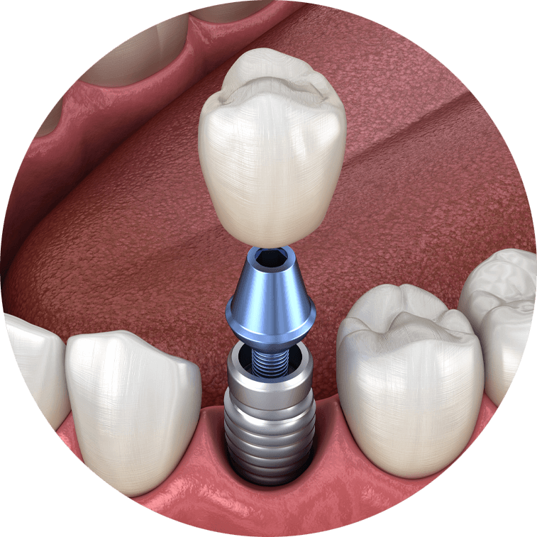 Single Implants