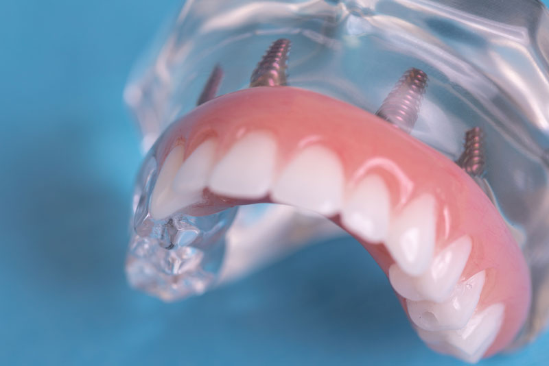 Full Arch Fixed Teeth