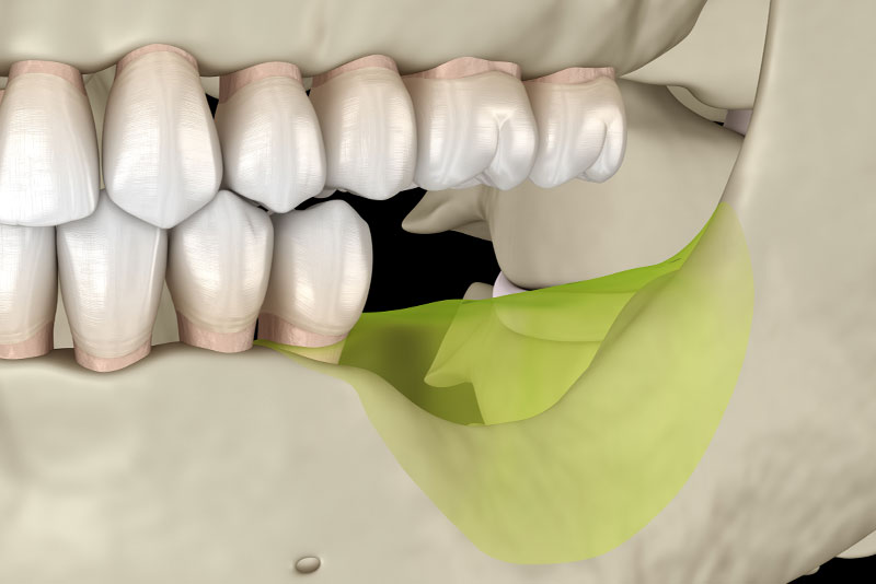 Ridge Augmentation