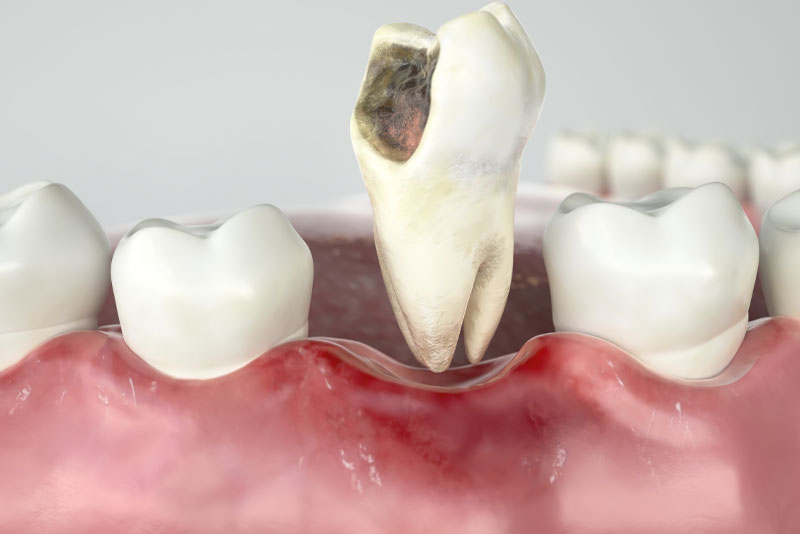 Tooth Extraction