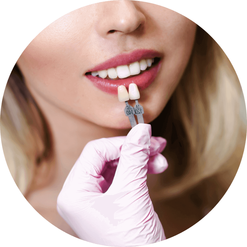 What Are Dental Veneers?
