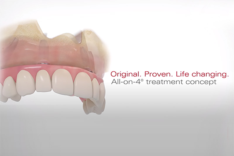All-On-X Implants