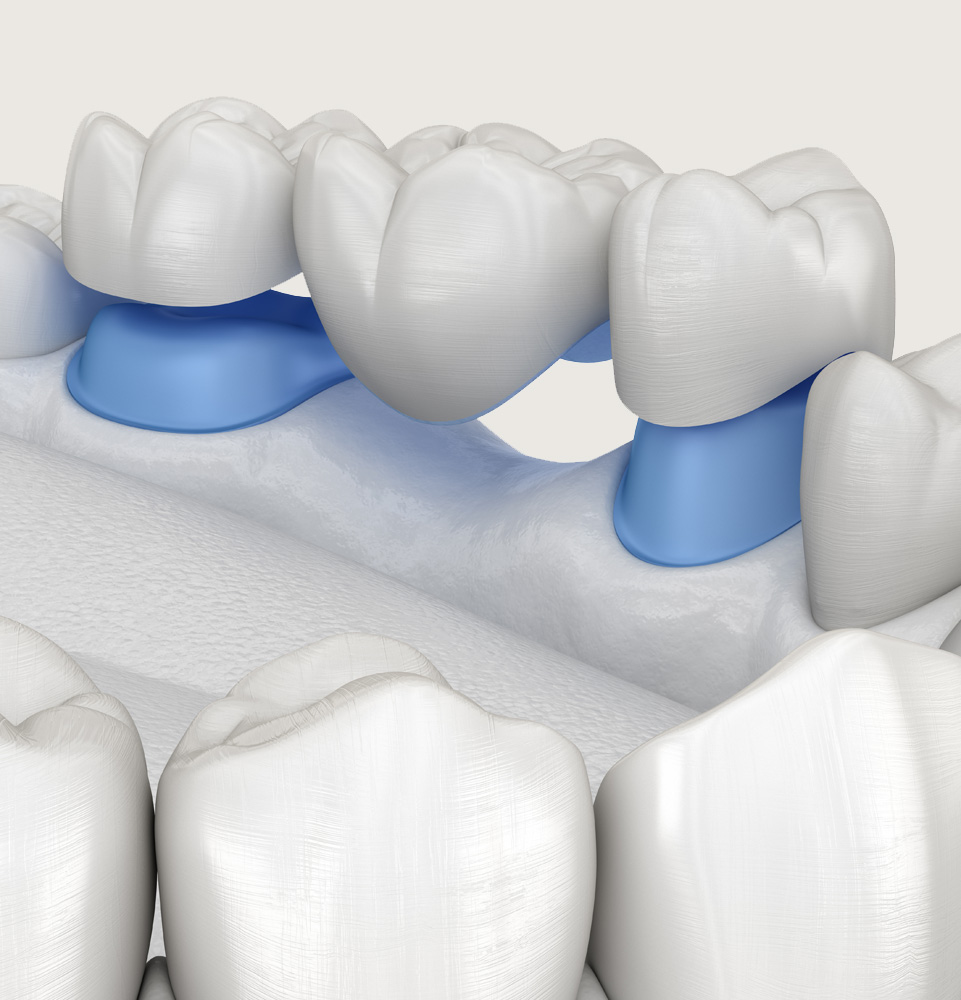 Dental Bridges: Replace A Missing Tooth