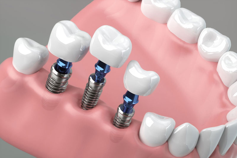 Three Single Dental Implants Being Placed Into A Jaw Model