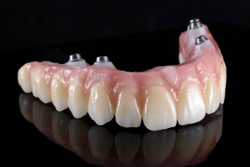 a picture of a zirconia fixed bridge with four dental implants in the gum line that can restore patients' smiles.