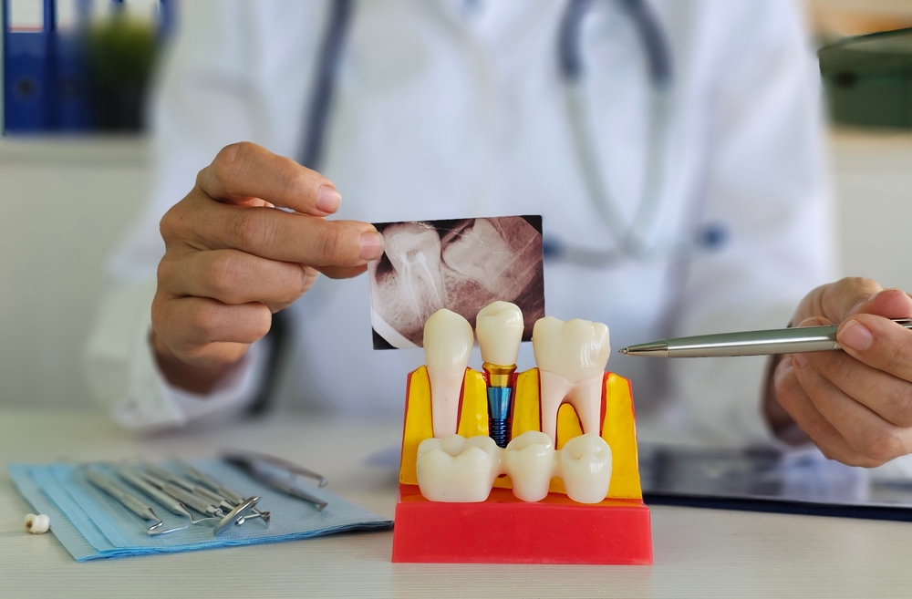 Medical Implants: More Than Just Dental Implants By Seminole, Florida