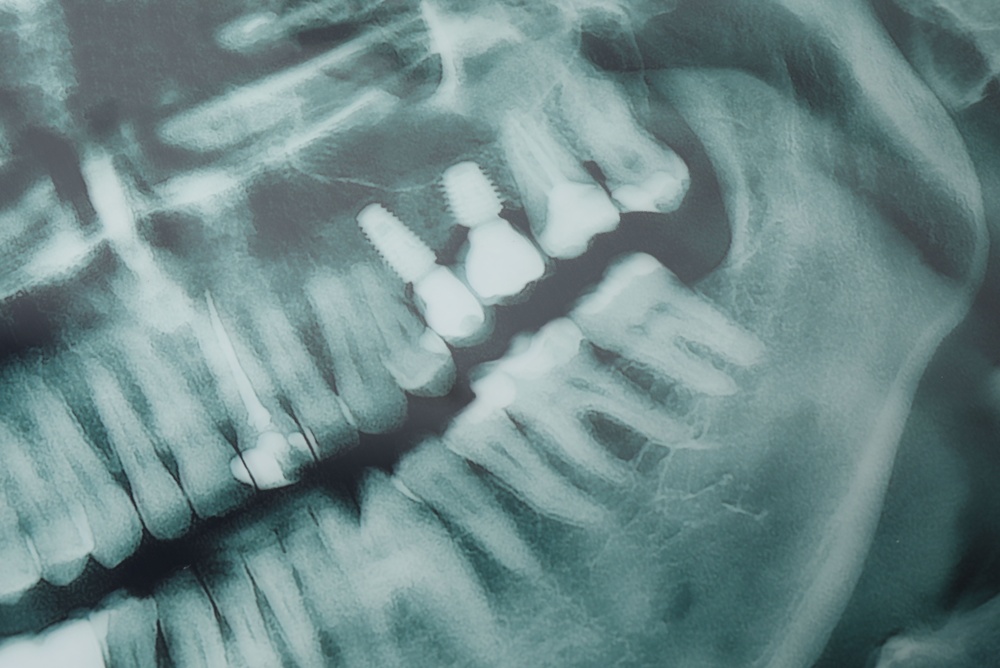 Implant Dental Options: Everything You Need To Know About Dental Implants